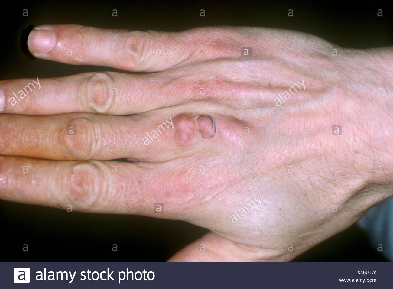 rheumaknoten fuß bilder