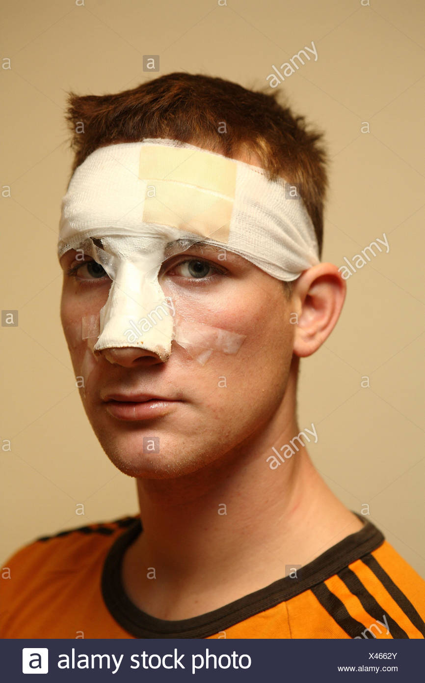 Broken Nose Stock Photos & Broken Nose Stock Images Alamy
