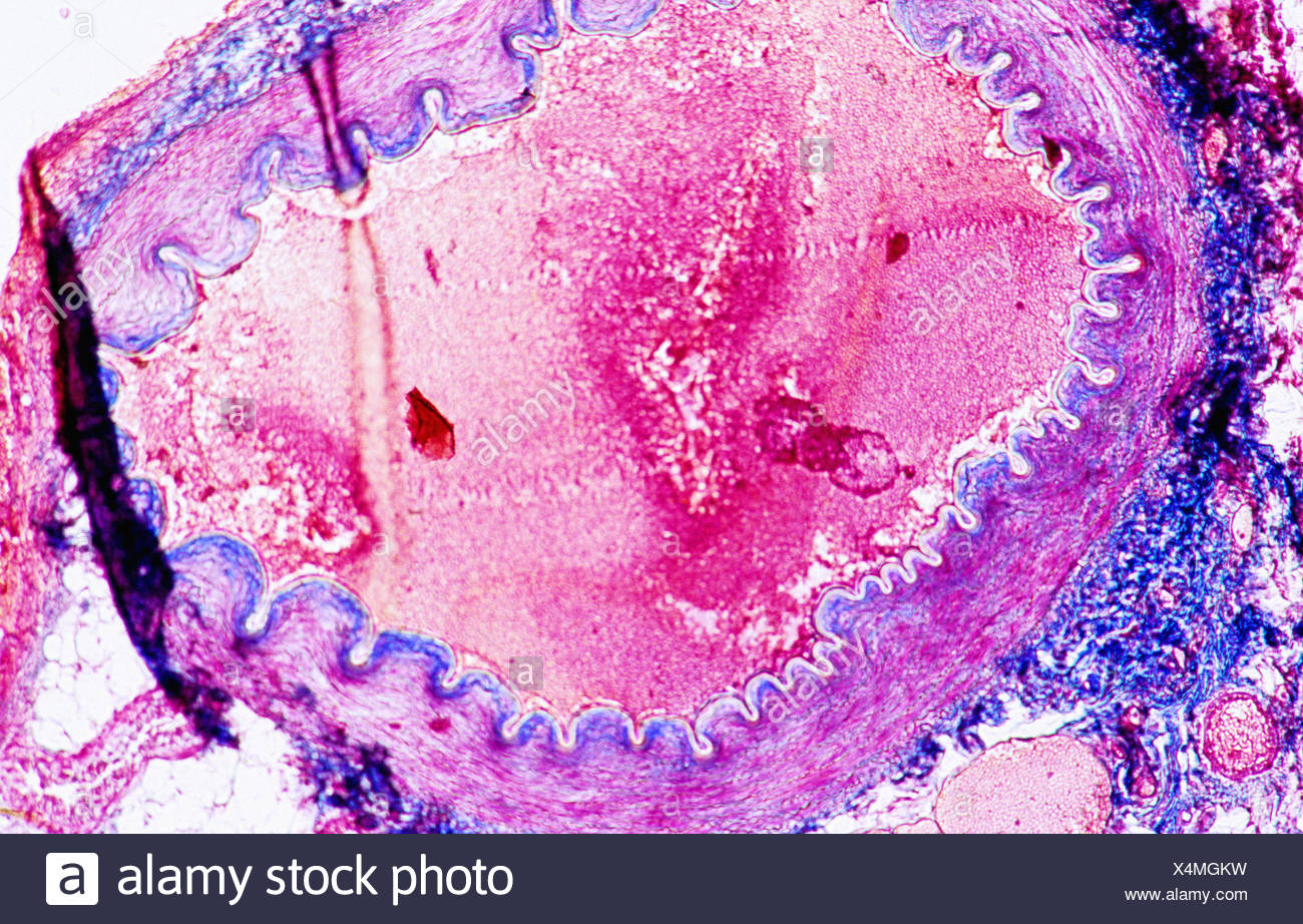 Бациллярный ангиоматоз гистология. Атерома гистология. Атерома кожи гистология. Атерома гистология микропрепарат. Атерома гистология.