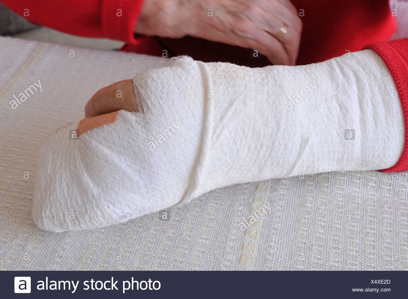 Both Arms Casts Stock Photos & Both Arms Casts Stock Images Alamy