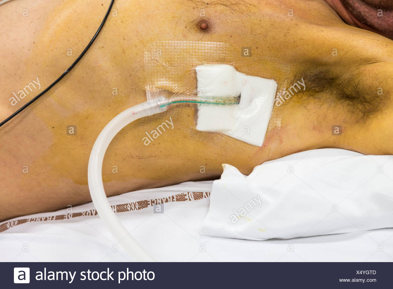 Chest Drain High Resolution Stock Photography and Images Alamy
