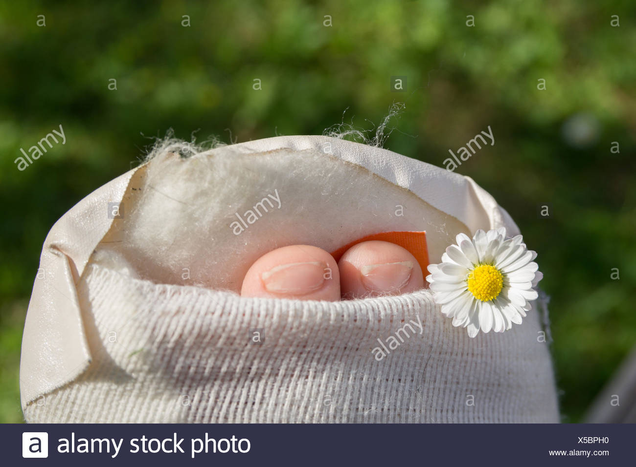Gipsfuß eines Kindes Stock Photo