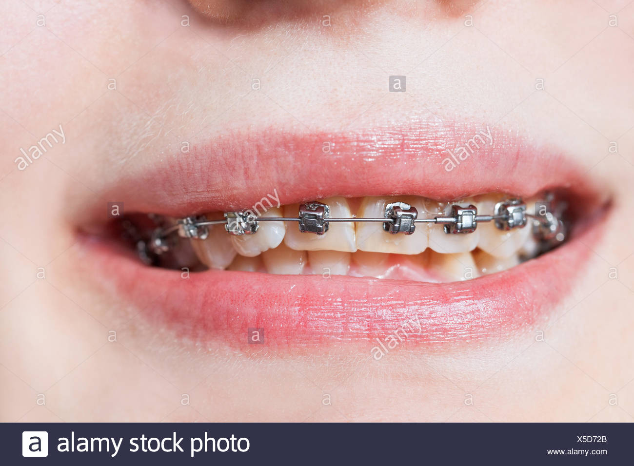 Self Ligating Braces High Resolution Stock Photography and Images Alamy
