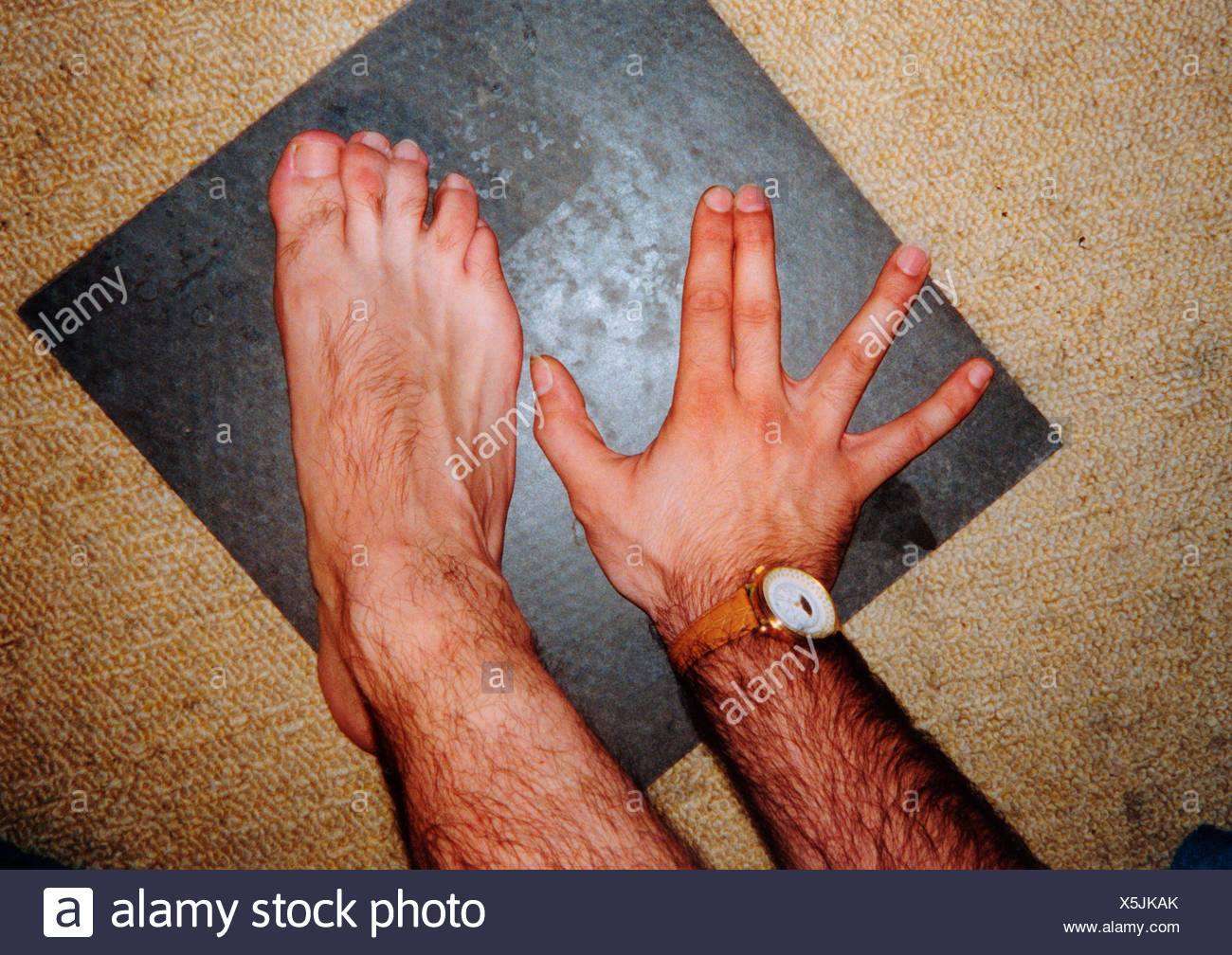 man with webbed toes which are joined together uk stock photo