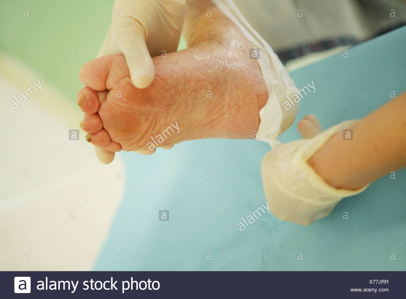 Bedsores Stock Photos & Bedsores Stock Images Alamy