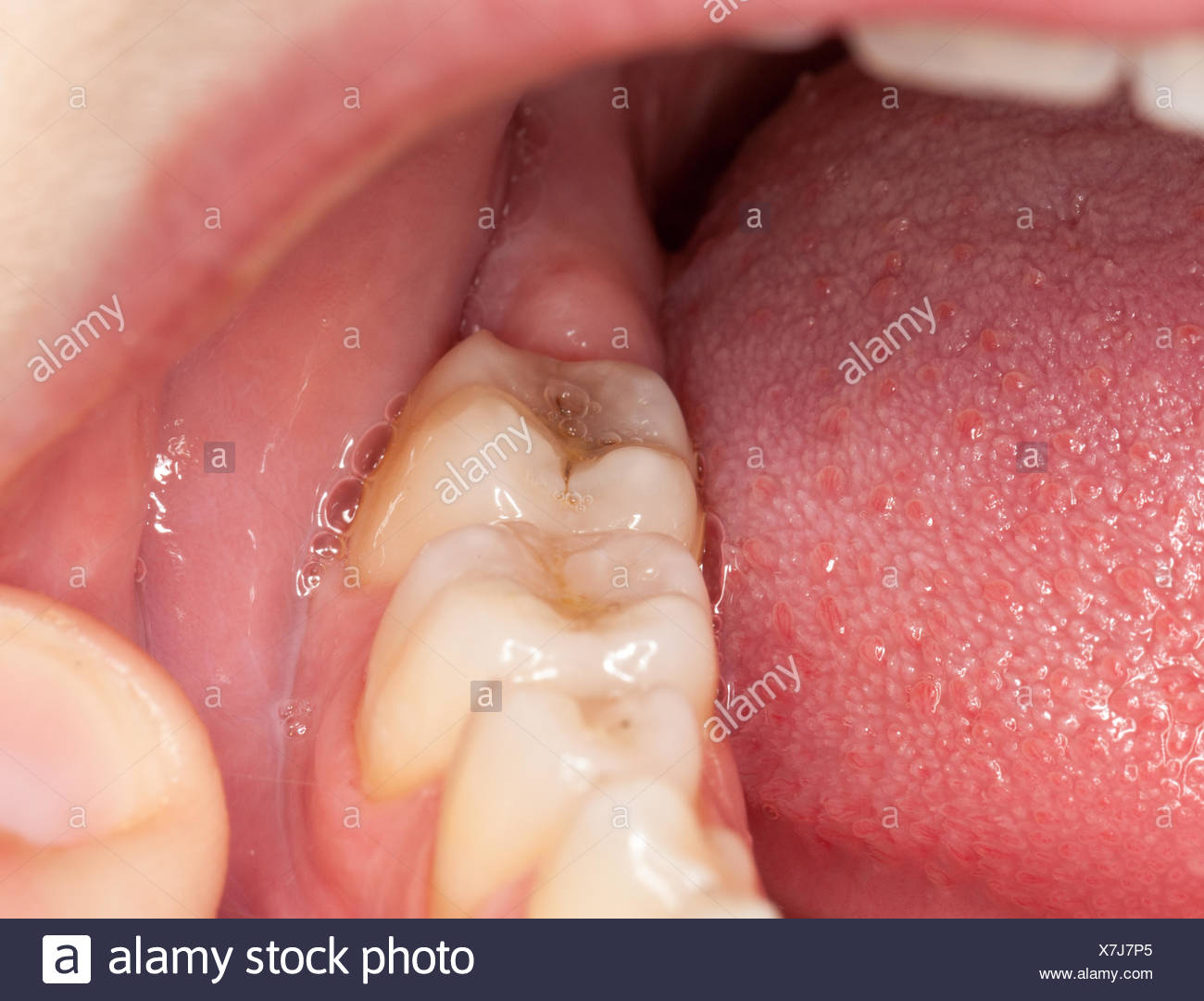 Gold Filling Teeth High Resolution Stock Photography and Images Alamy