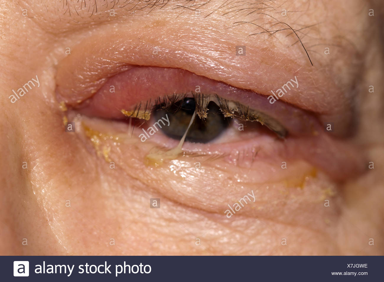 Infection Stock Photo