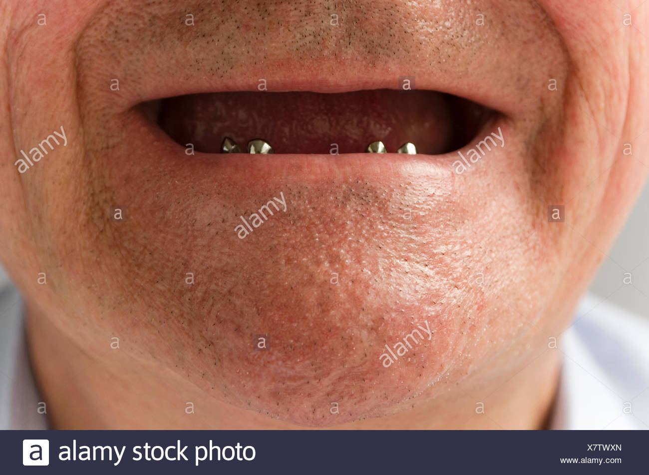 Teleskopzahnersatz High Resolution Stock Photography and Images Alamy