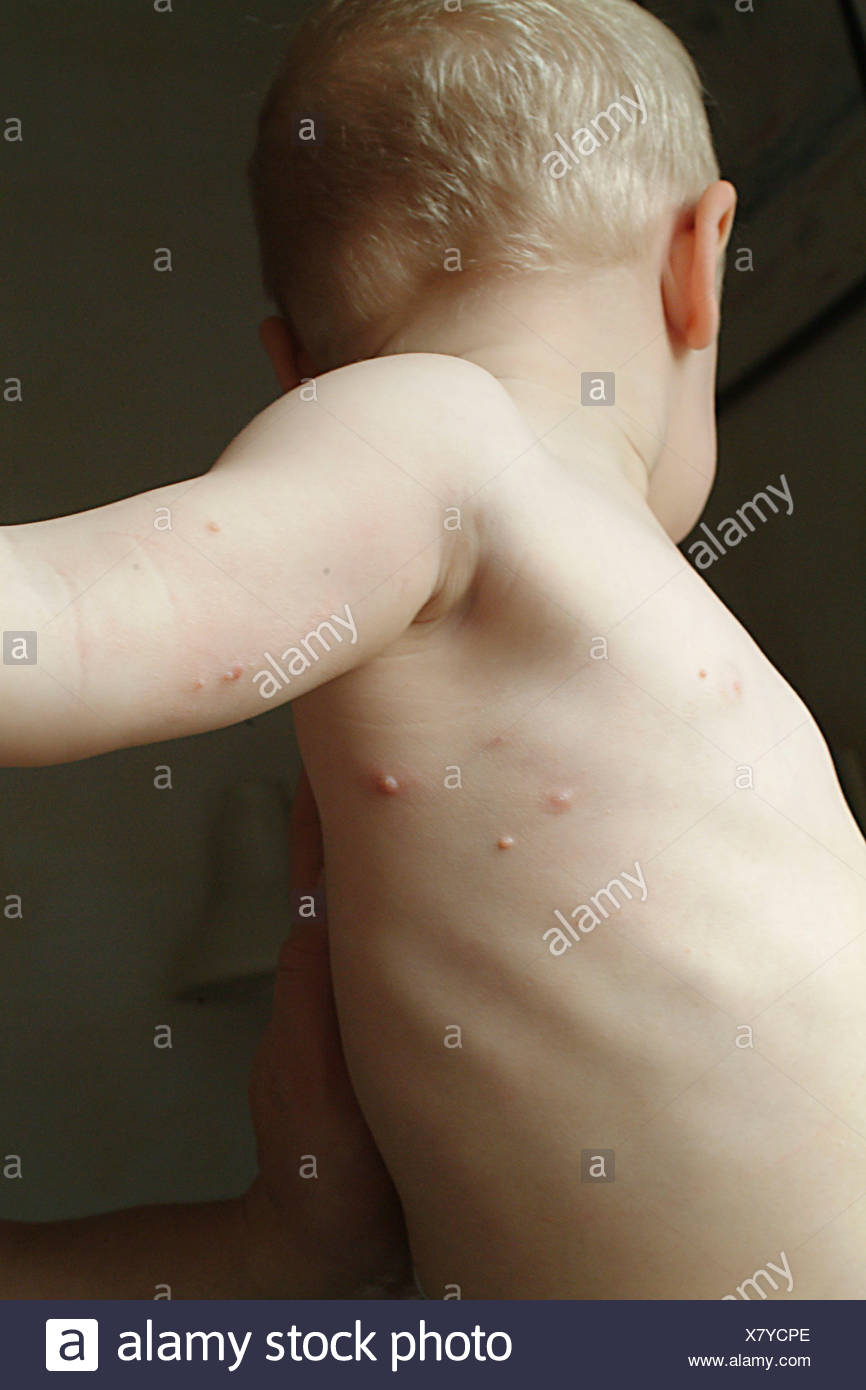 Wart Child High Resolution Stock Photography and Images Alamy