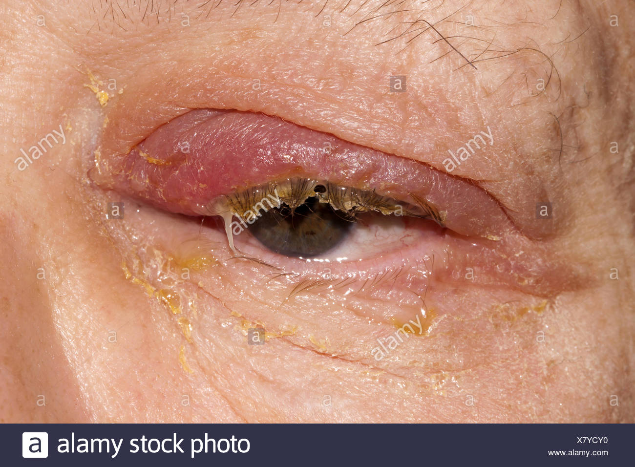 Infection Stock Photo
