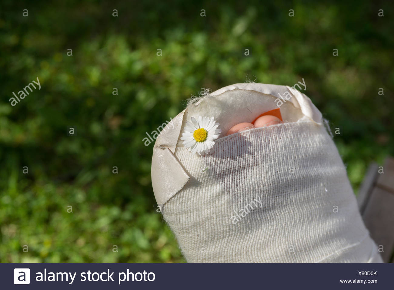 Gipsfuß eines Kindes Stock Photo