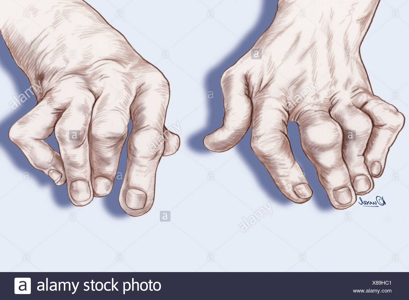 Rheumatoid Arthritis Hands Stock Photos \u0026 Rheumatoid