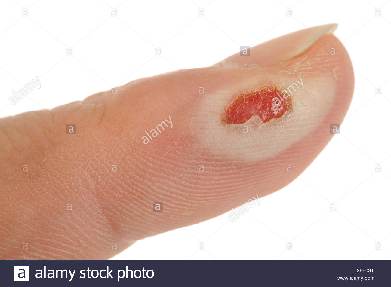 Second Degree Burn High Resolution Stock Photography and Images Alamy