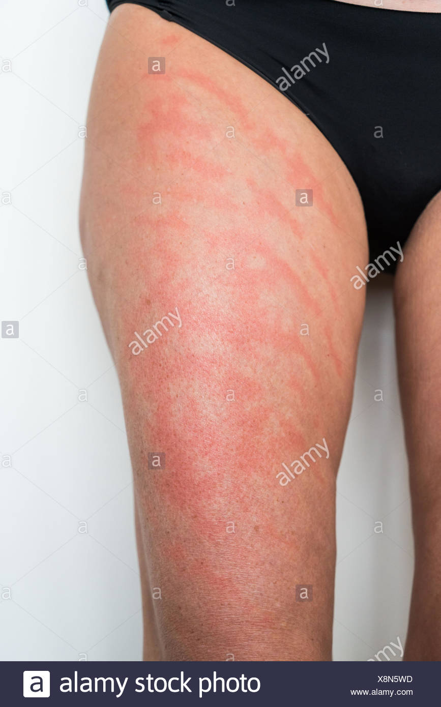 Dermatitis Contact High Resolution Stock Photography and Images Alamy