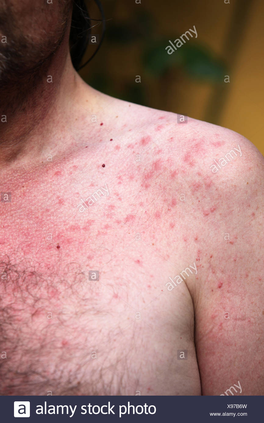 Allergy To The Sun High Resolution Stock Photography and Images Alamy