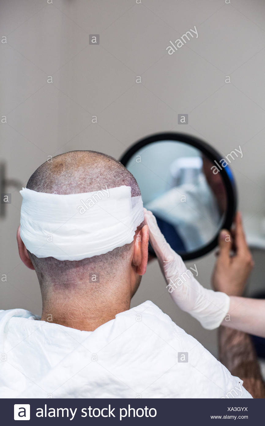 Follicular Unit Extraction High Resolution Stock Photography and Images ...