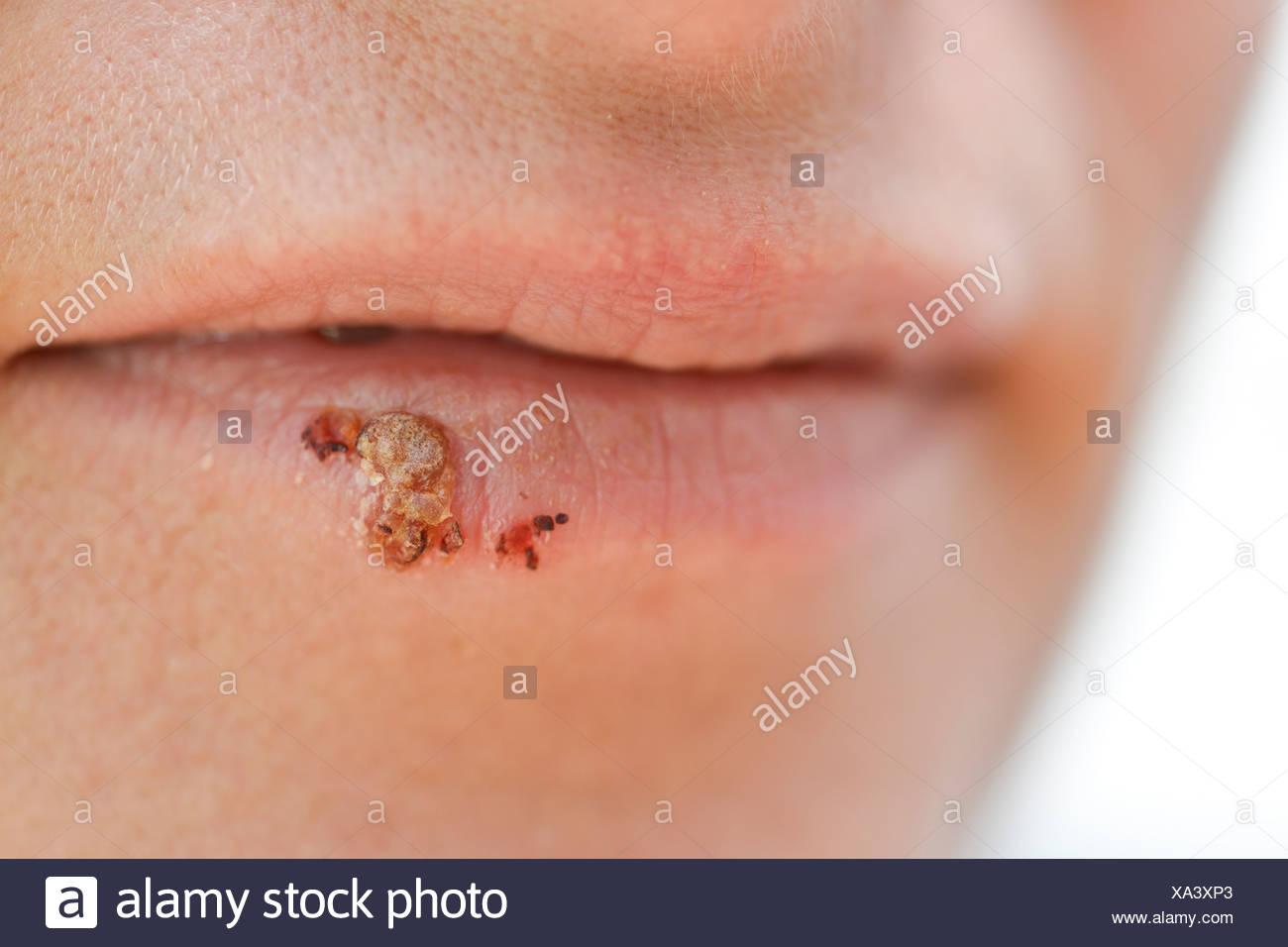 Herpes Simplex Labialis High Resolution Stock Photography and Images