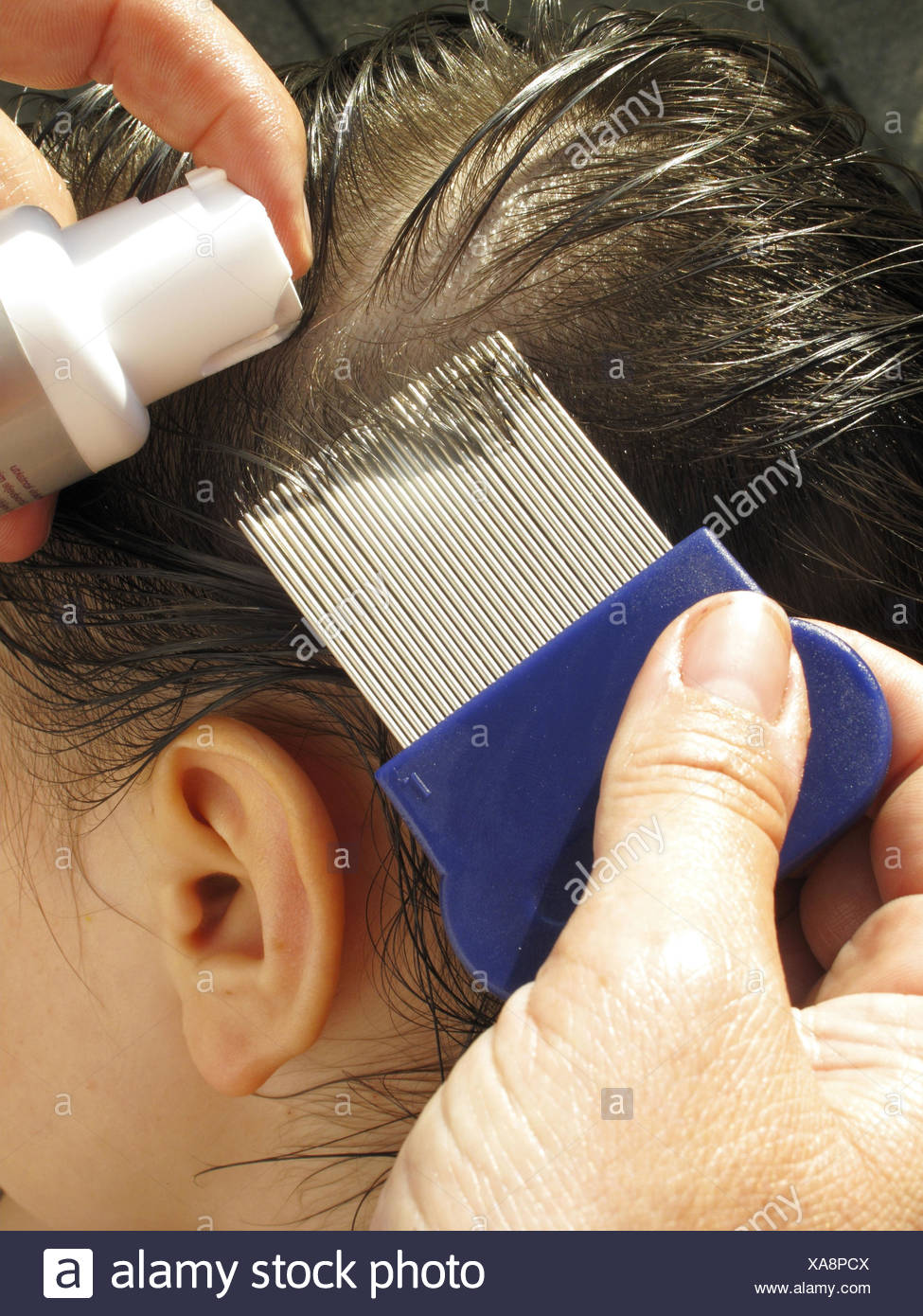 Head Lice Child Stock Photos Head Lice Child Stock Images Alamy