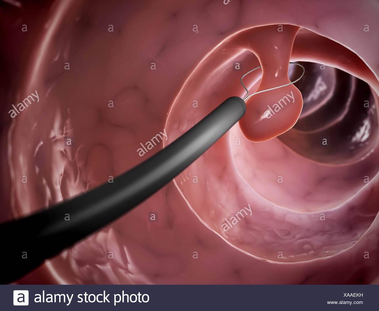 Colonoscopy Polyp Removal colonoscopy-a-journey-though-the-colon-and-removal-of-polyps-youtube