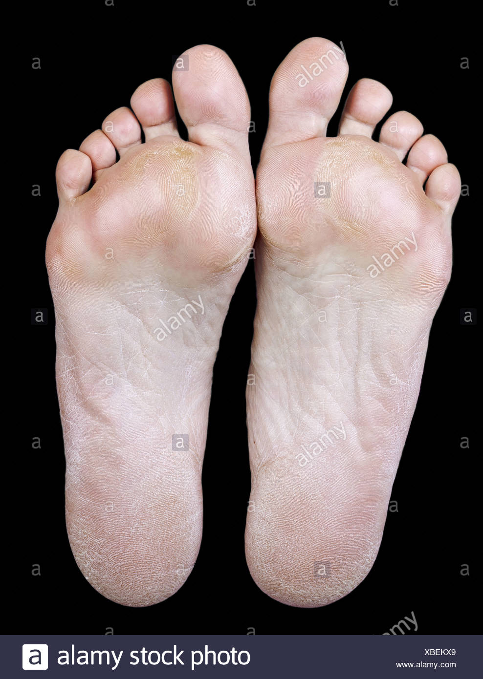 Calluses Stock Photos & Calluses Stock Images - Alamy
