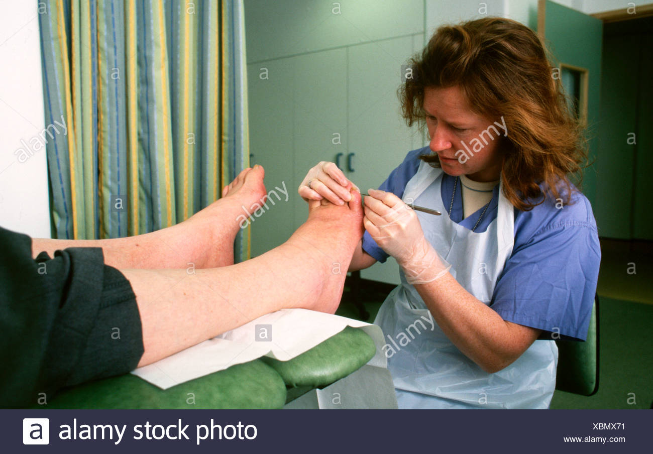 Diabetic Foot Stock Photos & Diabetic Foot Stock Images Alamy