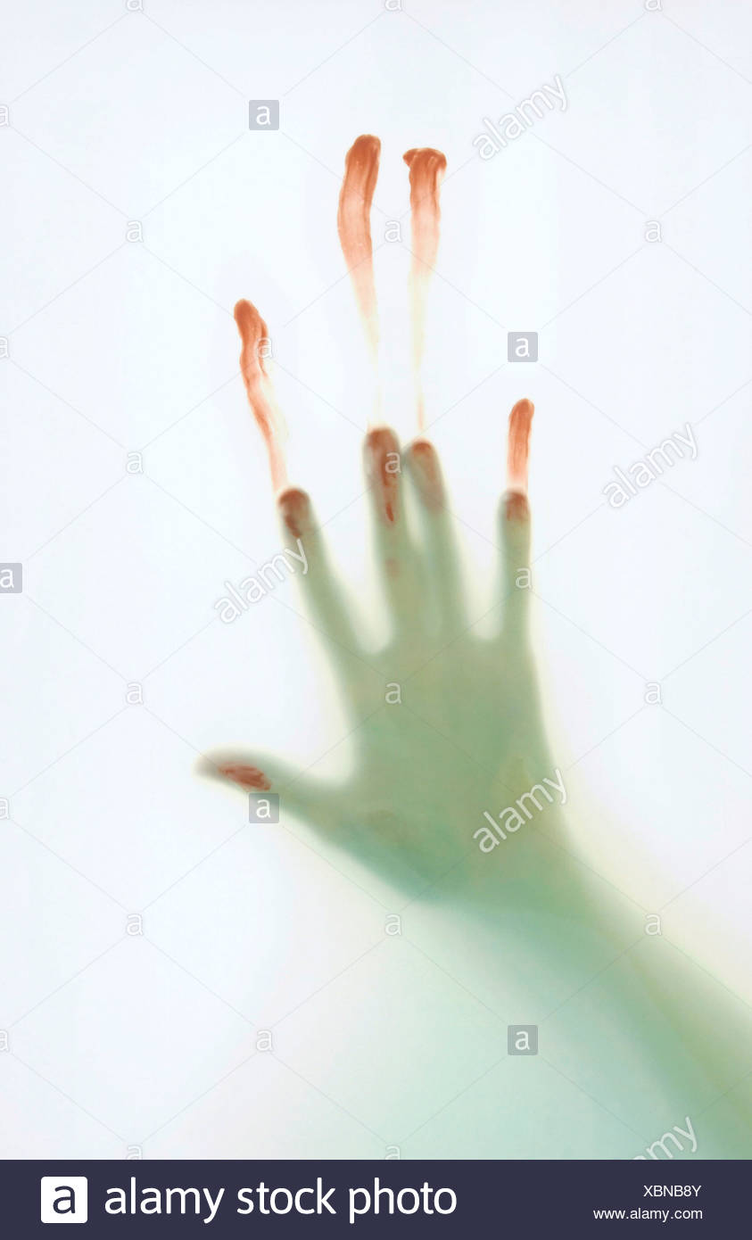 Hand Injuries Stock Photos & Hand Injuries Stock Images Alamy