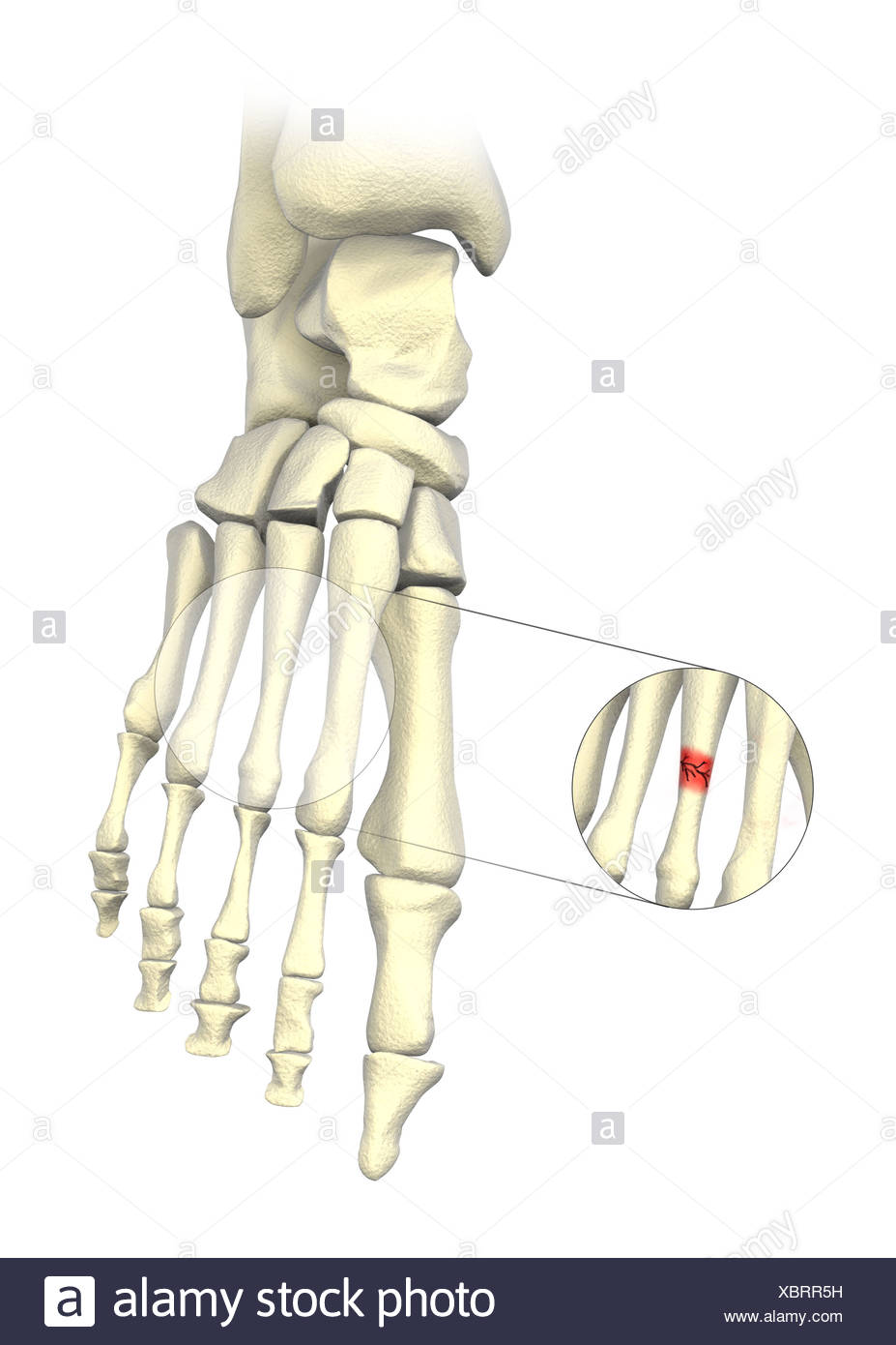 Fatigue Fracture Stock Photos & Fatigue Fracture Stock Images Alamy