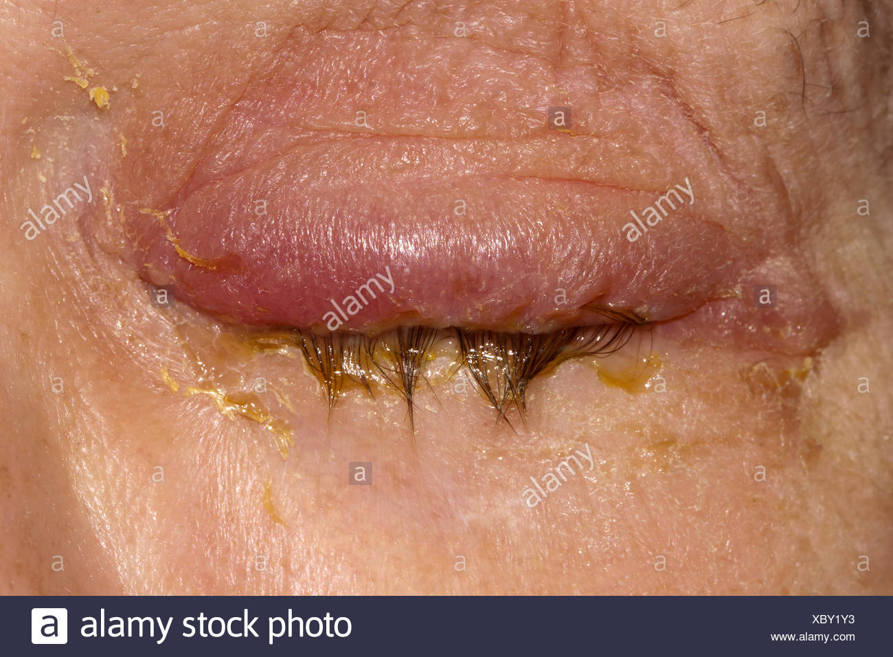 Infection Stock Photo