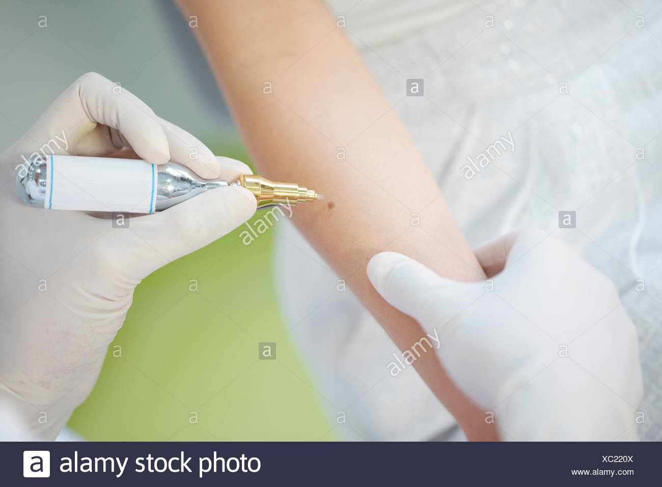 with treatment skin nitrogen liquid Photos Liquid Stock Nitrogen Nitrogen Treatment Liquid &