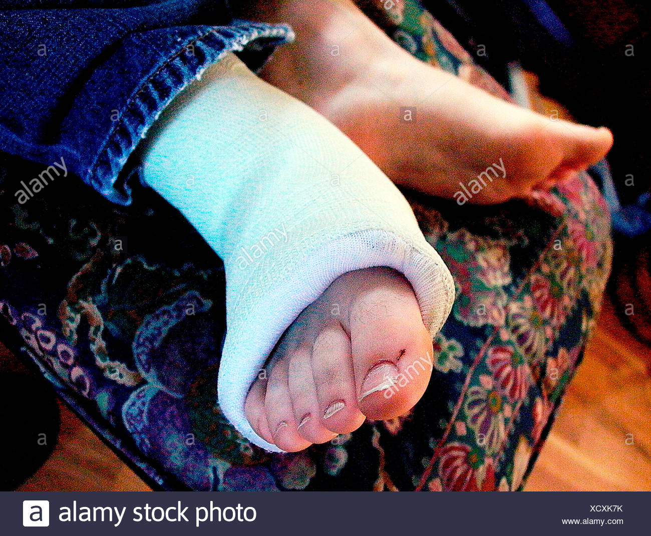 Broken Foot High Resolution Stock Photography and Images - Alamy
