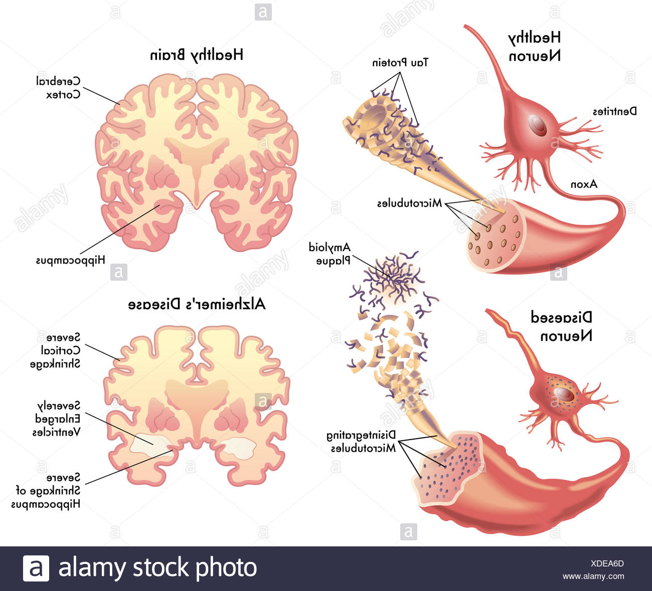 Senile Plaques High Resolution Stock Photography and Images Alamy