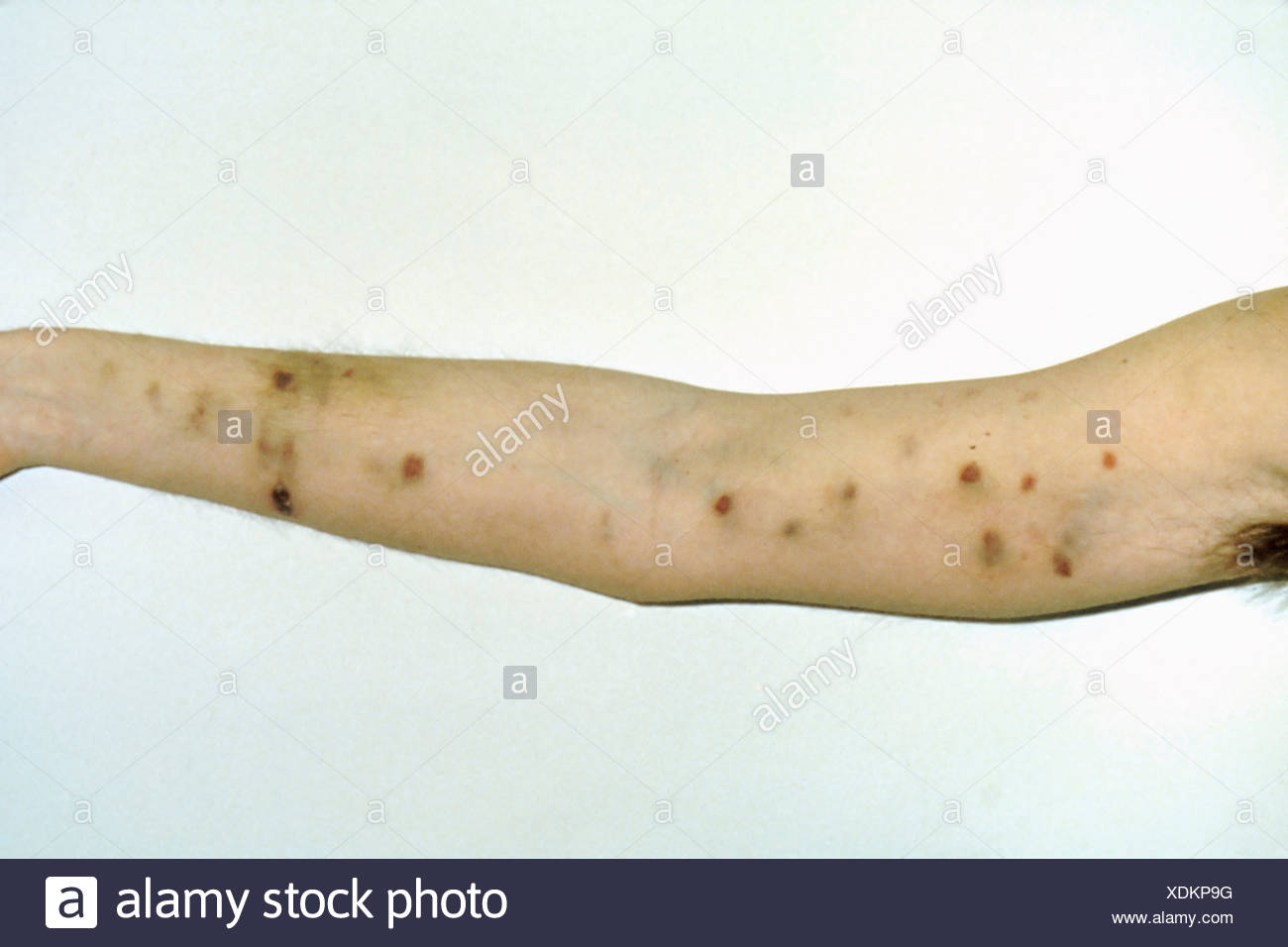 Kaposi's Stock Photos & Kaposi's Stock Images Alamy