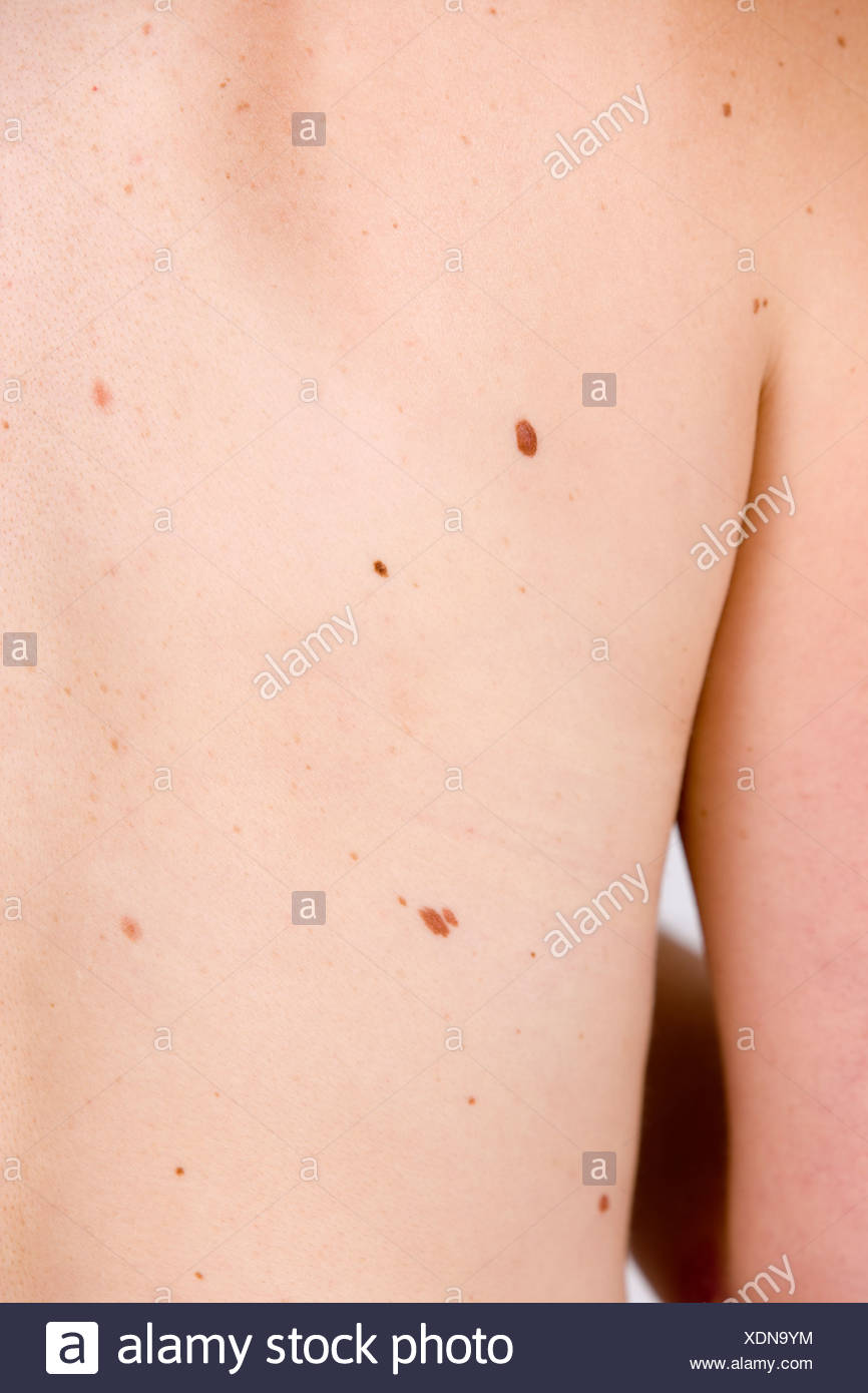 Skin Cancer Spots On Back