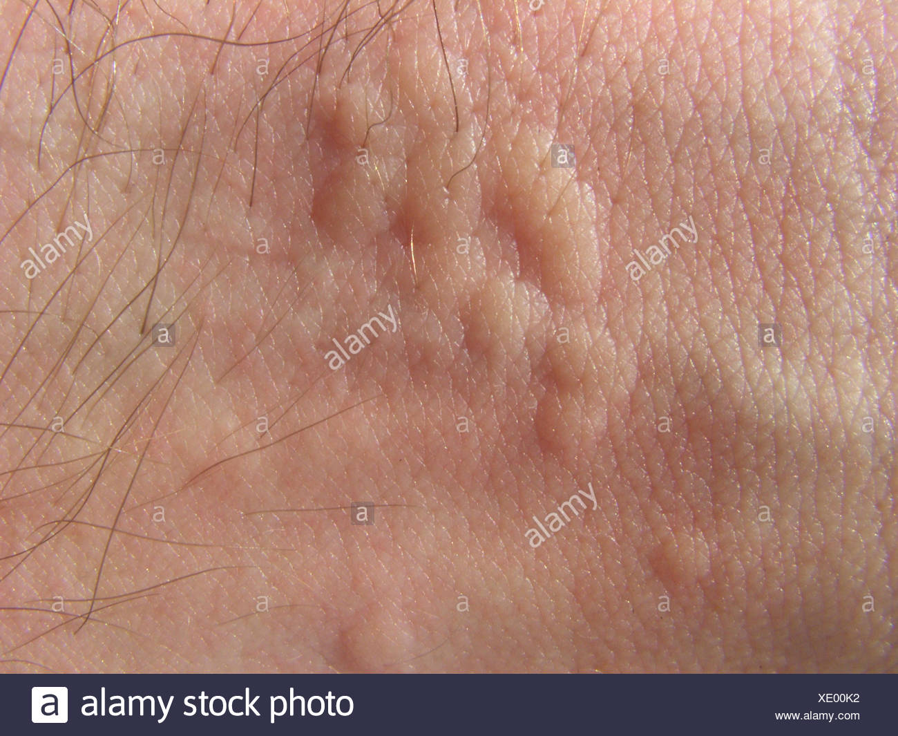Skin Irritation High Resolution Stock Photography and Images Alamy