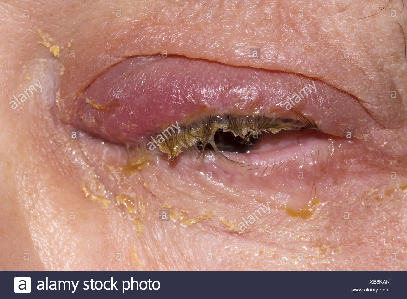 Infection Stock Photo