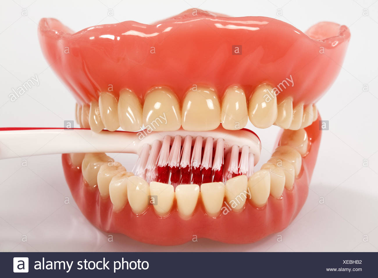 Clasp prosthesis for upper jaw Clasp prosthesis for upper jaw