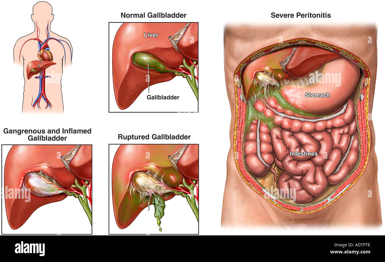 Куда отдает боль желчного пузыря. Перфорация желчного пузыря перитонит. Острый холецистит перфорация желчного пузыря. Аппендицит с перитонитом операция. Гнойный перитонит операция.