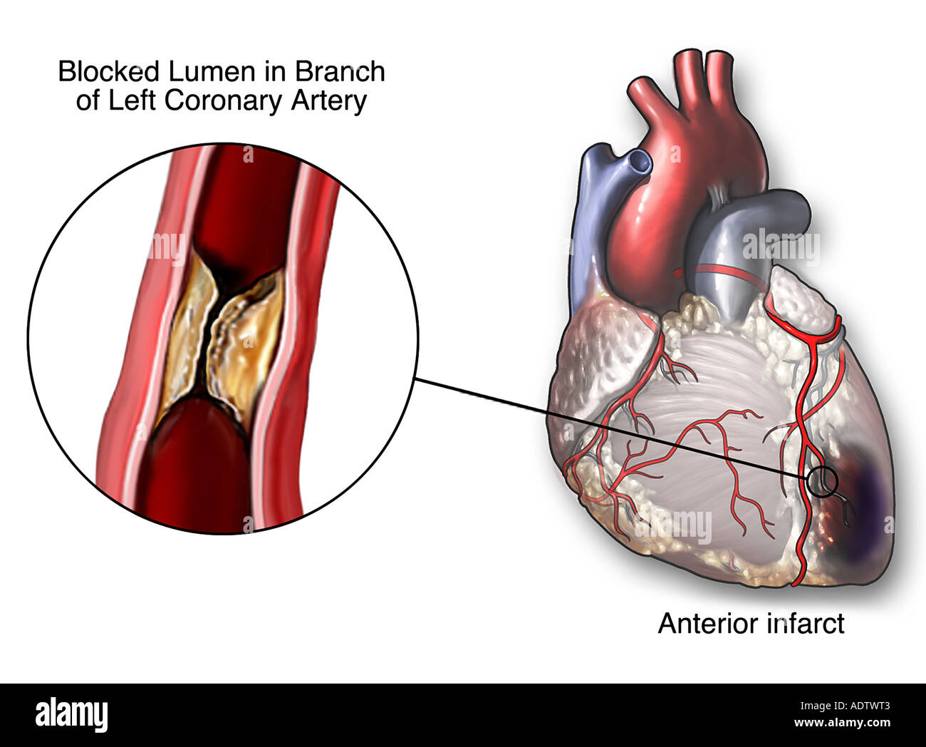 атеросклероз коронарных артерий симптомы. инфаркт коронарных артерий. атеросклероз аорты и коронарных артерий. инфаркт миокарда сердце. строение сердца при инфаркте миокарда.