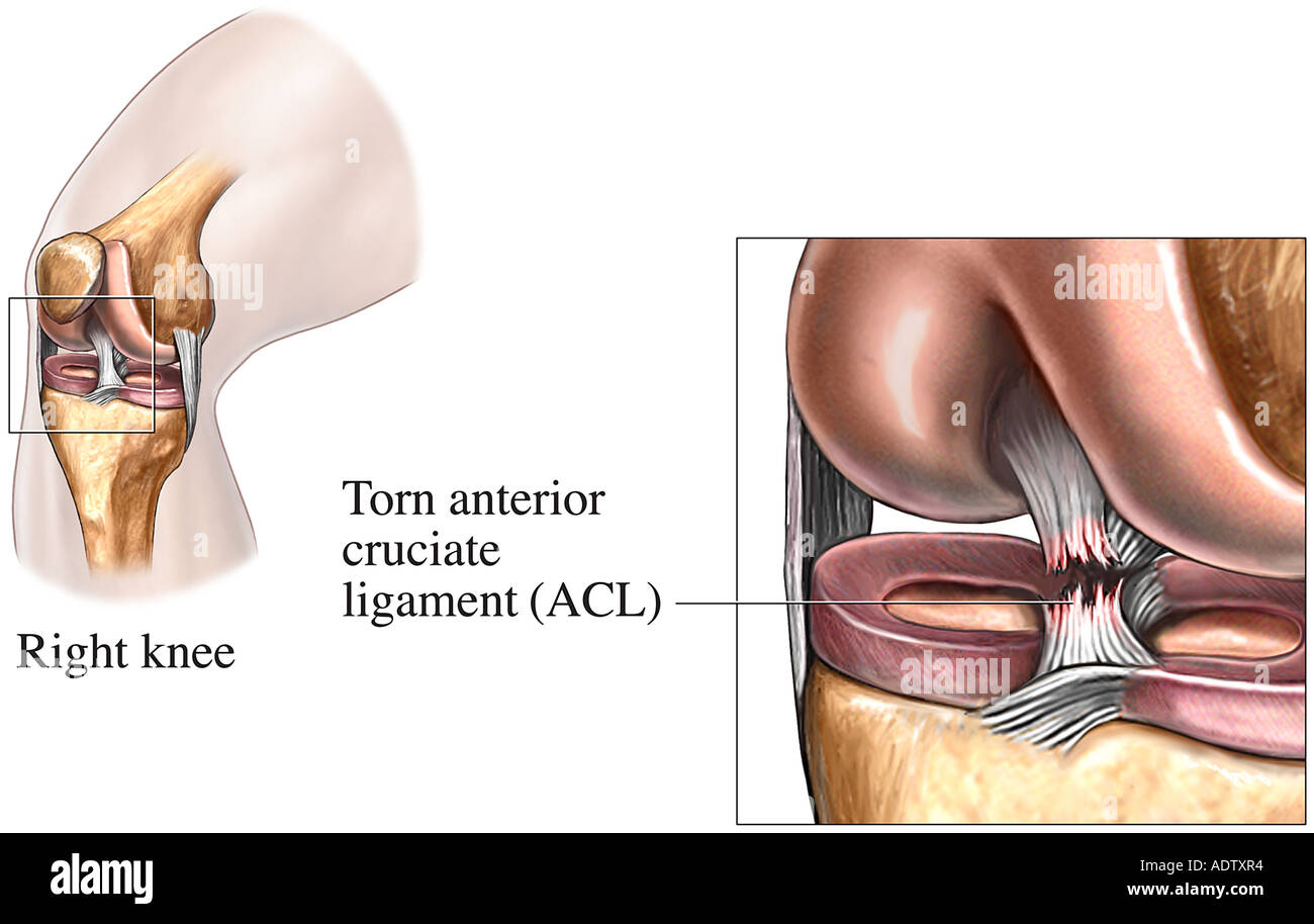 Повреждение передней крестообразной связки коленного сустава фото
