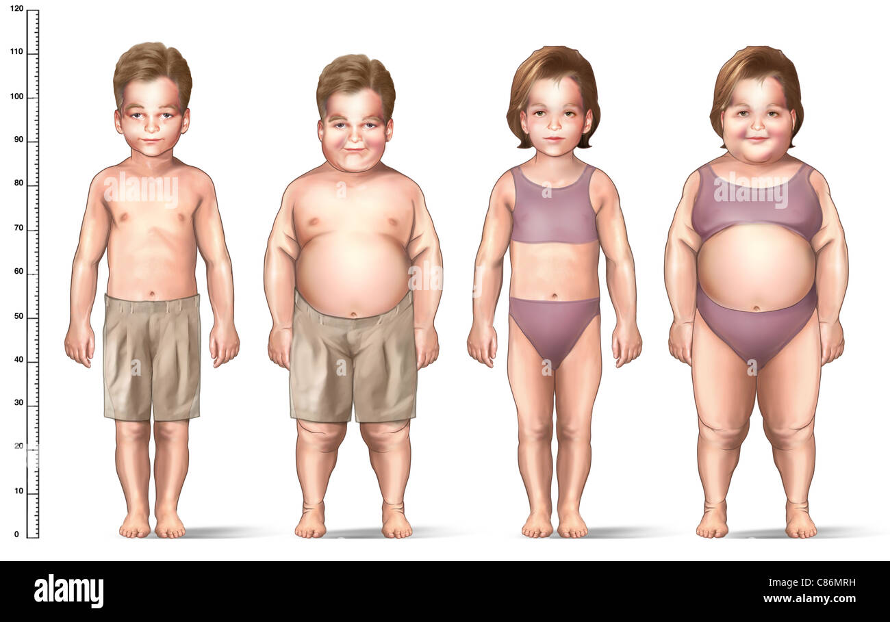 Ожирение 3 степени у детей