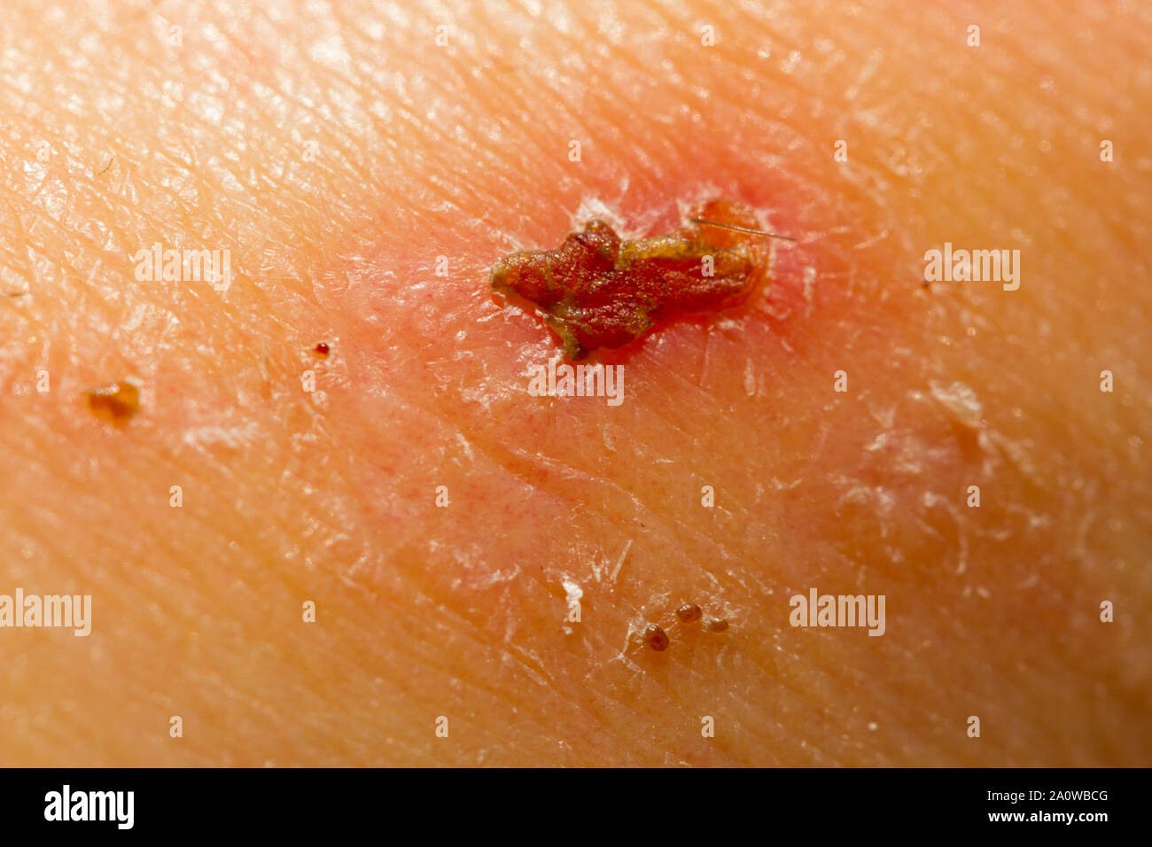 Eine extreme Detailansicht einer heilenden Wunde Stockfoto