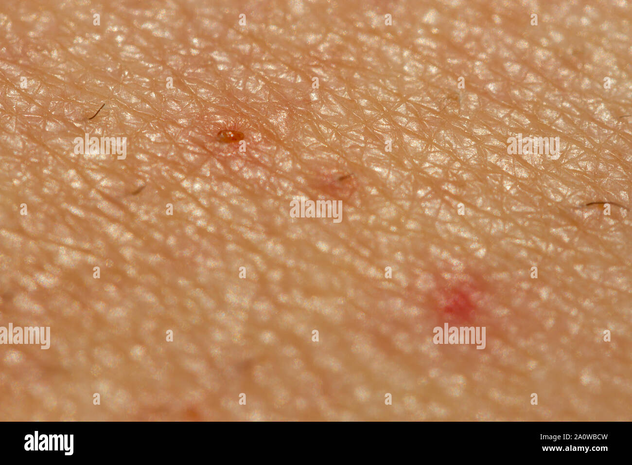 Eine extreme Detailansicht einer heilenden Wunde Stockfoto