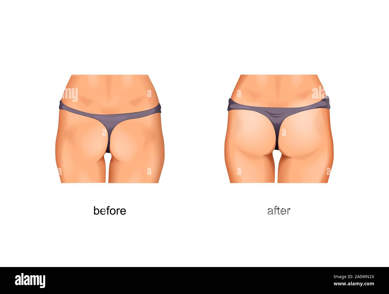 Vector Illustration von straff Gesäßmuskulatur. vor und nach den Behandlungen oder Fitness Stock Vektor Vector Illustration von straff Gesäßmuskulatur. vor und nach den Behandlungen oder Fitness Stock Vektor