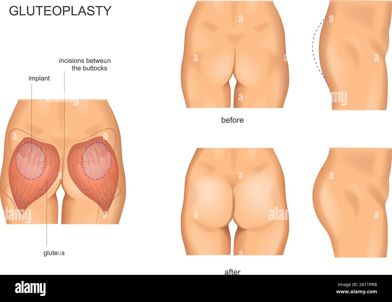 Vector Illustration Hinterteil der Augmentation. gluteoplasty. Chirurgie Stock Vektor