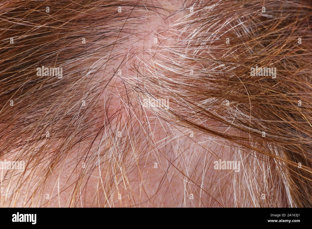 Wunde fettige Haut und dünne graue Haare auf dem Kopf eines älteren ältere Frau. Studio Makroaufnahme Stockfoto