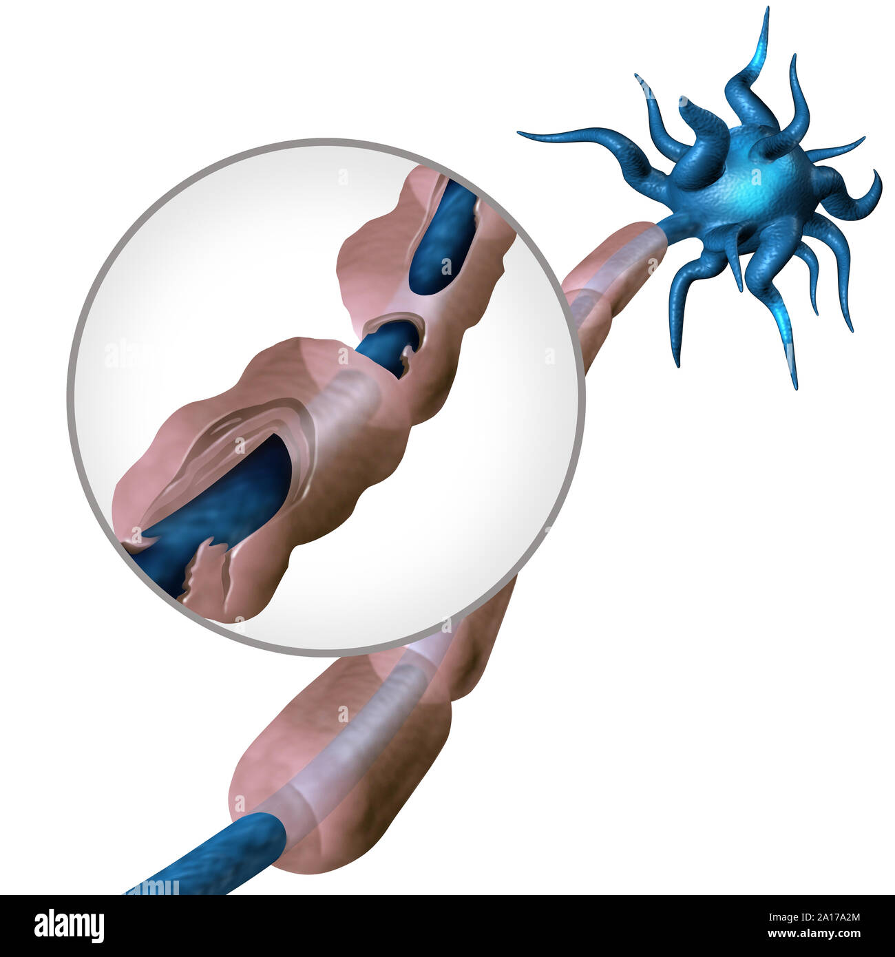 Multiple Sklerose Diagramm Konzept oder MS Autoimmunkrankheit Anatomie mit gesunden Nerv und beschädigte Myelin mit freiliegender Faser mit scarrred schwann. Stockfoto