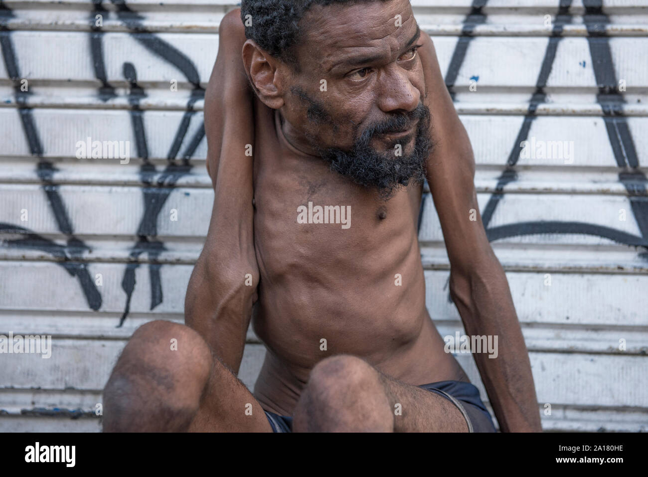 Obdachlose Menschen mit angeborenen Krankheit in den Bürgersteig weg schauen Stockfoto