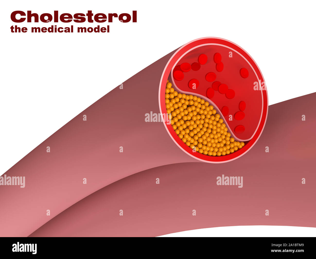 Modell des Cholesterins in der Arterie Stockfoto