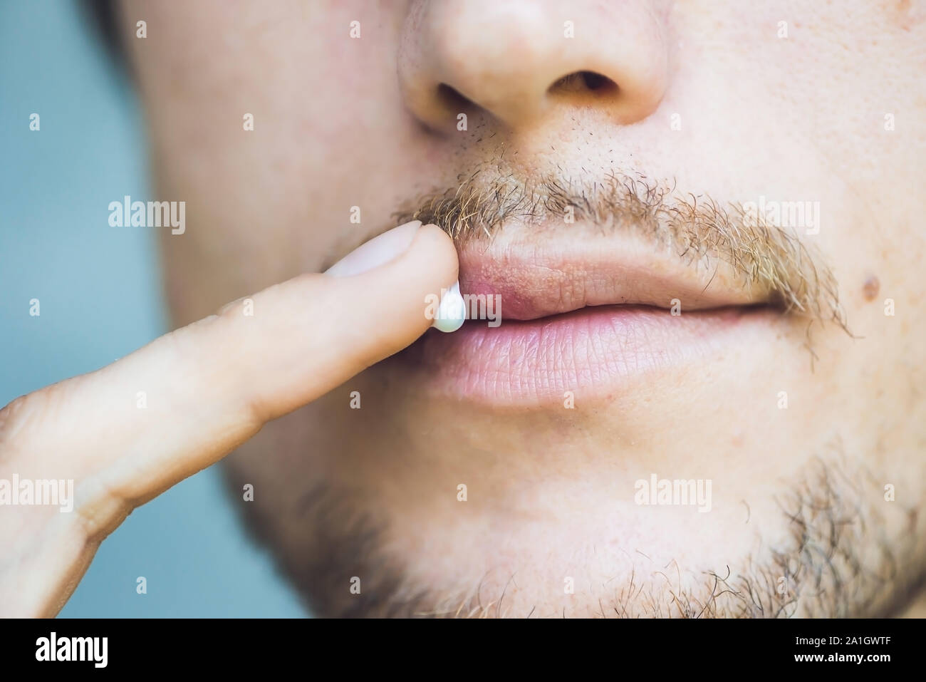 Herpes auf den Lippen des jungen Mannes. Man schmiert Herpes mit Herpes Creme. Stockfoto