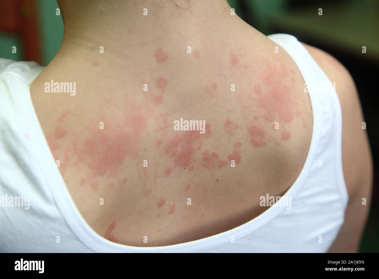 Allergische Dermatitis. Die Haut auf dem Rücken des Mädchens wird von Dermatitis erstaunt Stockfoto